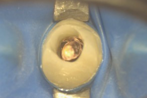 名古屋市名東区の自費の根管治療