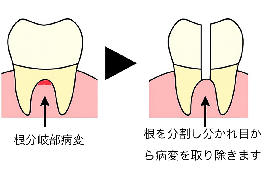 名古屋市名東区の歯周外科治療