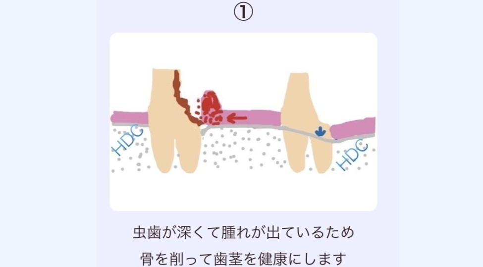 歯質の残存量の診断