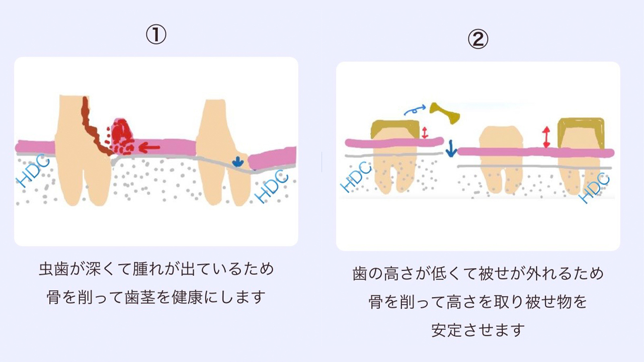 クラウンレングスニング （歯冠長延長術）
