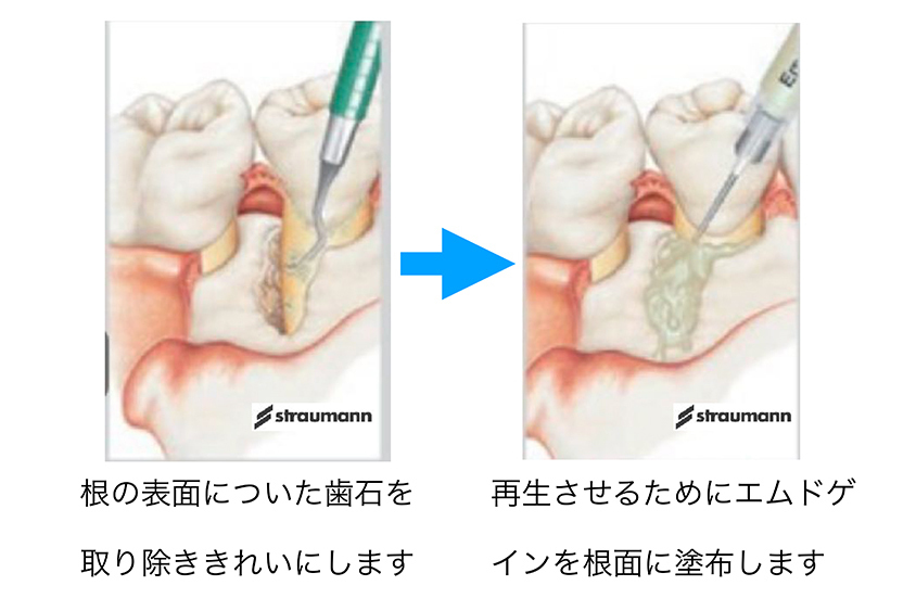 名古屋市名東区の歯周外科治療