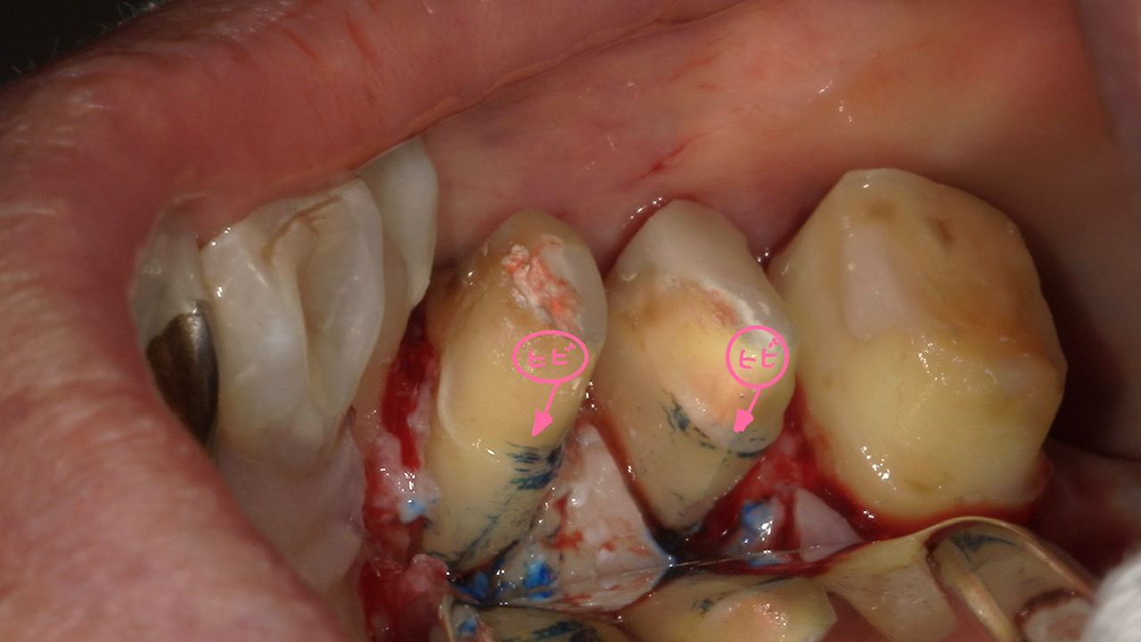 名古屋市名東区の自費の根管治療