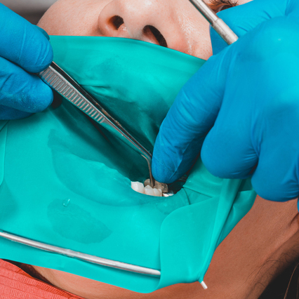 名古屋市名東区の虫歯の治療