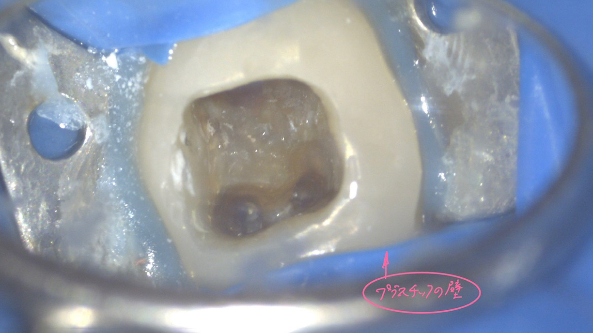 名古屋市名東区の自費の根管治療