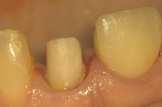 名古屋市名東区の自費の根管治療