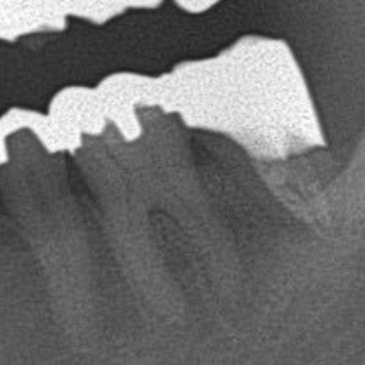 虫歯が深く、綺麗にかぶせられないためクラウンレングスニングを行った症例