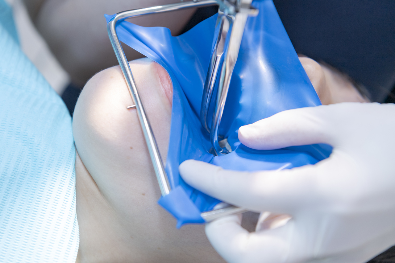 名古屋市名東区の自費の根管治療