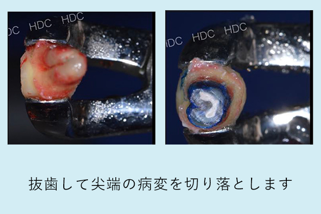 名古屋市名東区の自費の根管治療