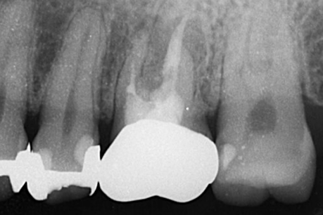 名古屋市名東区の歯周外科治療