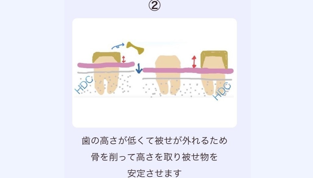 歯質の残存量の診断