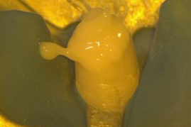 名古屋市名東区の自費の根管治療