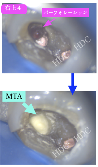 名古屋市名東区の自費の根管治療