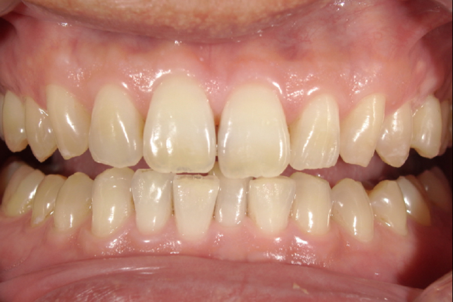 名古屋市名東区のホワイトニング