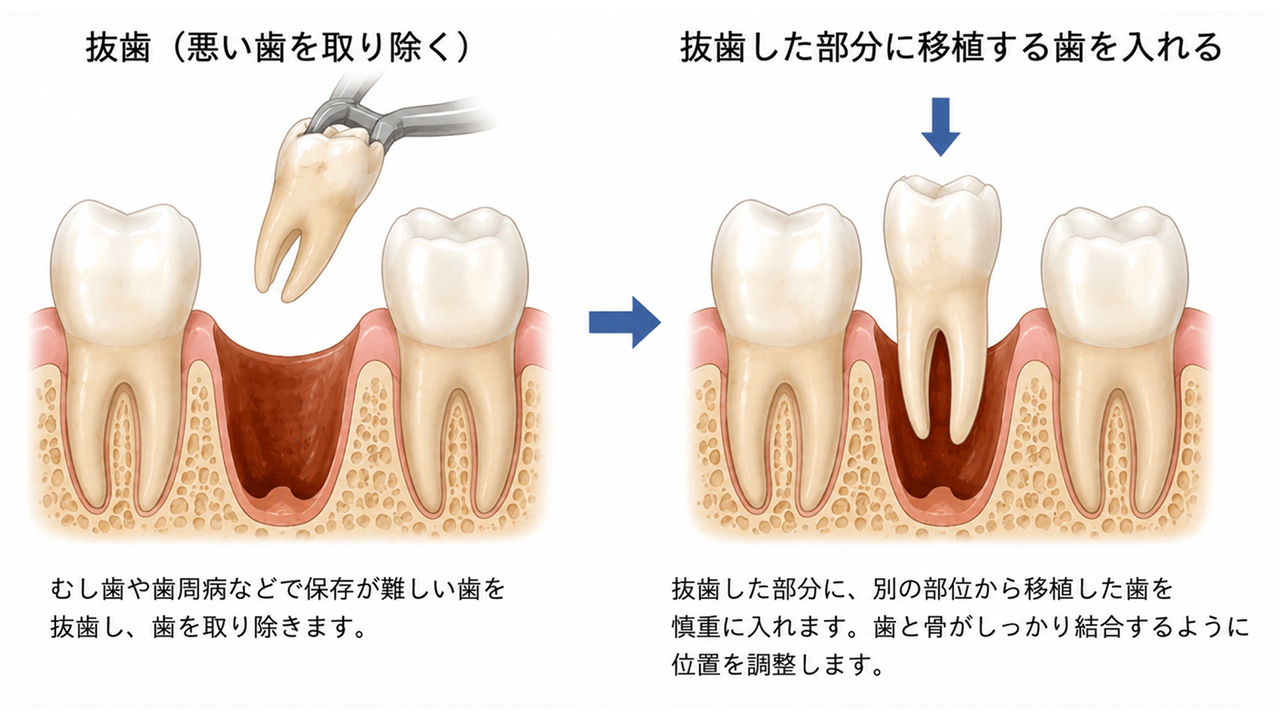 歯牙移植による歯の保存