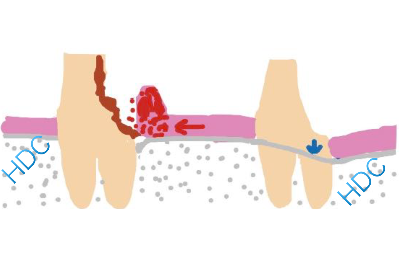 名古屋市名東区の歯周外科治療