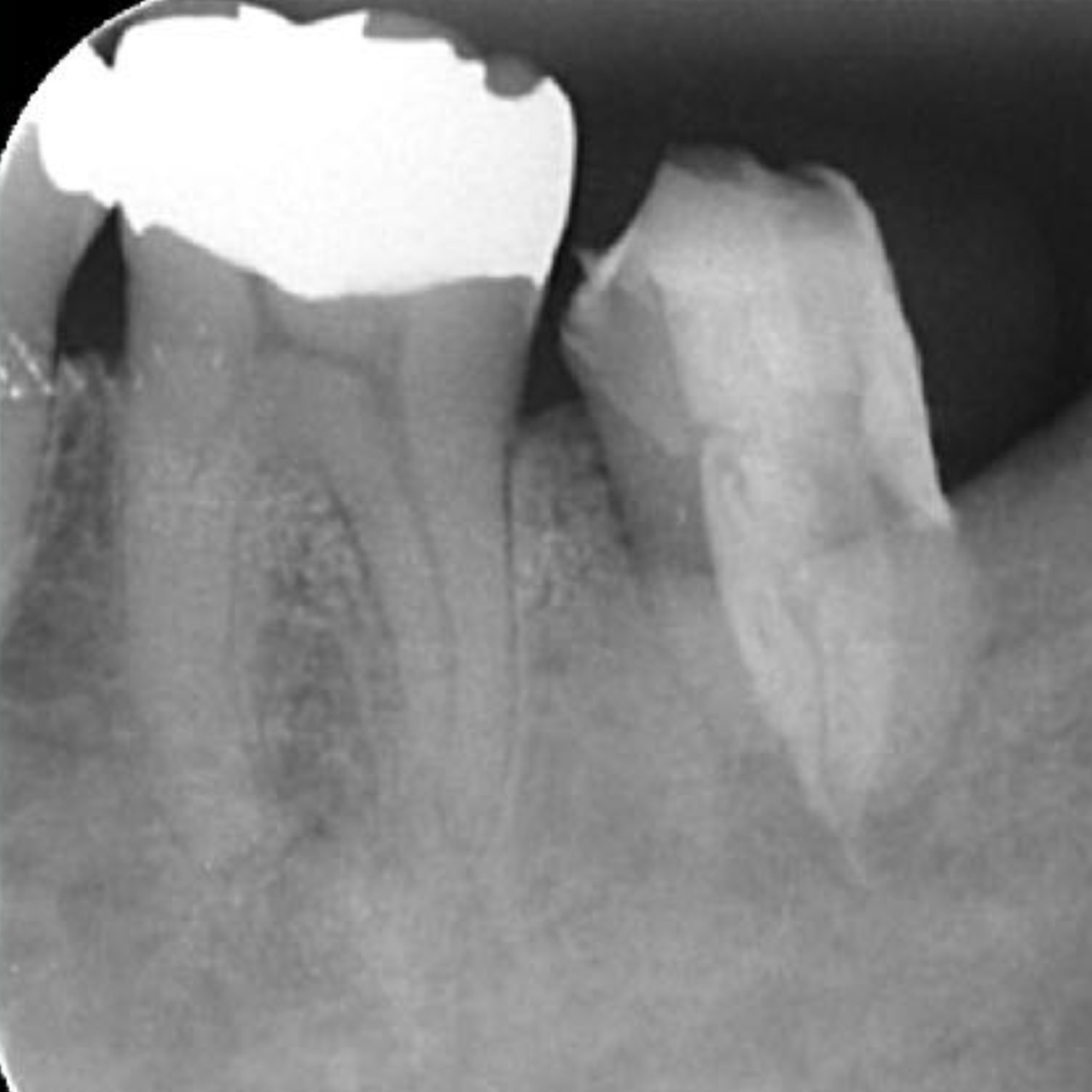 虫歯が深く、綺麗にかぶせられないためクラウンレングスニングを行った症例