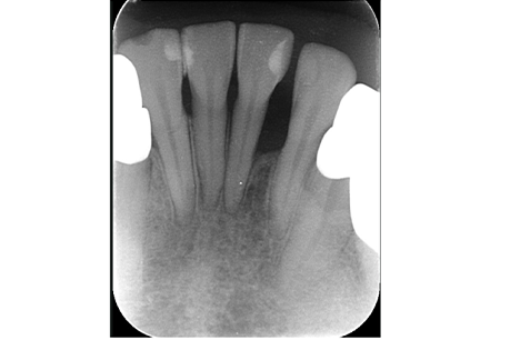名古屋市名東区の歯周外科治療