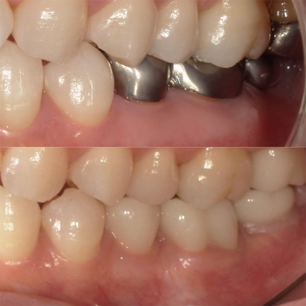 名古屋市名東区の歯周外科治療