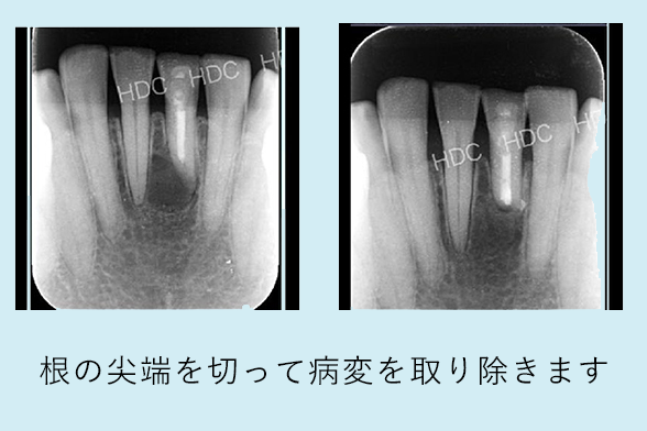 名古屋市名東区の自費の根管治療