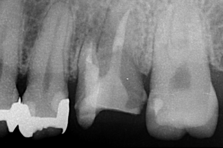 名古屋市名東区の歯周外科治療