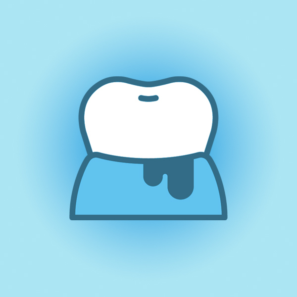 名古屋市名東区の歯周病の治療