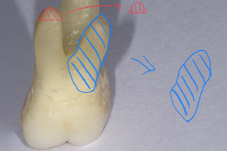 名古屋市名東区の歯周外科治療