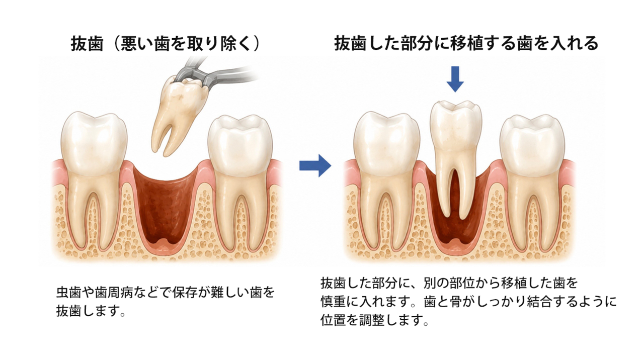 名古屋市名東区の親知らずの抜歯