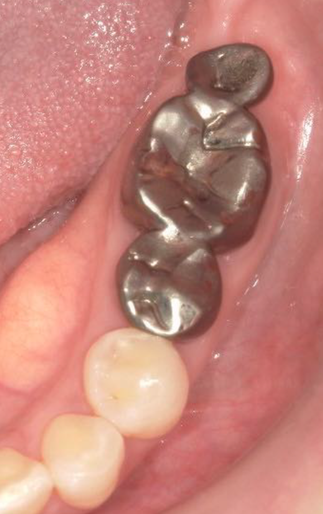 名古屋市名東区の歯周外科治療