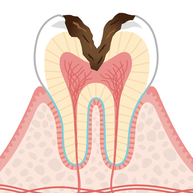 名古屋市名東区の虫歯の治療