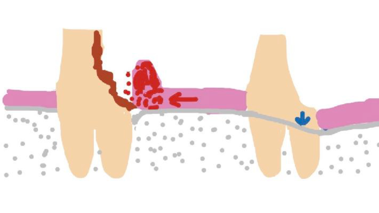 虫歯が深く、綺麗にかぶせられないためクラウンレングスニングを行った症例