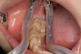 名古屋市名東区の自費の根管治療