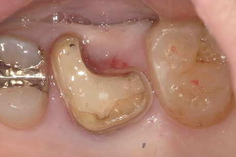 名古屋市名東区の歯周外科治療