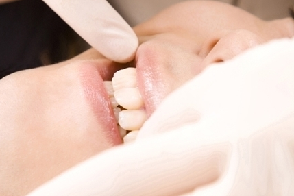 名古屋市名東区の虫歯の治療